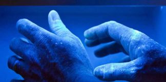 effectiveness of uv light therapy for psoriatic arthritis
