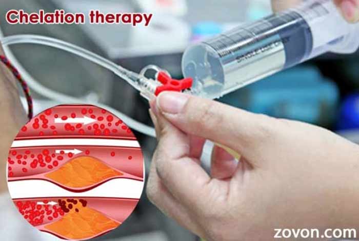 chelation therapy how and when