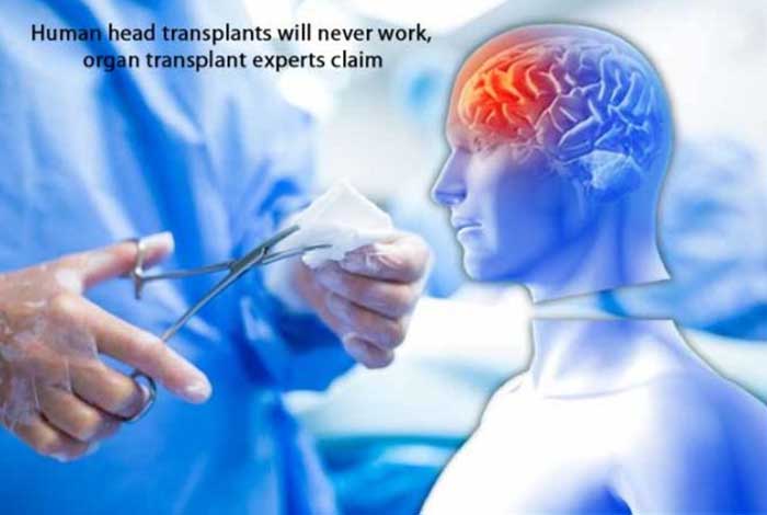 human head transplants will never work organ transplant experts claim