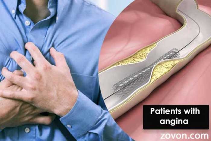 stent procedure is not useful for patients with angina study claims