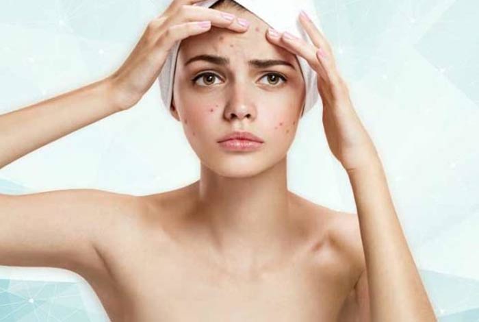 13 essential home remedies for acne