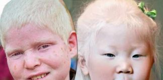 albinism types symptoms causes treatment and prevention
