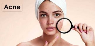 all about acne causes & treatments types prevention and symptoms