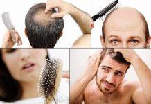 baldness symptoms causes pattern prevention and treatment