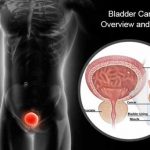 bladder cancer types causes symptoms prevention and treatment