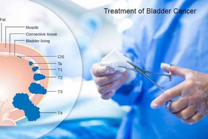 bladder cancer surgery