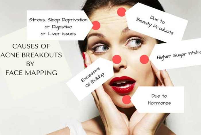 causes and prevention of acne