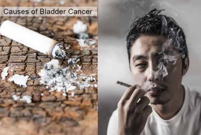 causes and prevention of bladder cancer