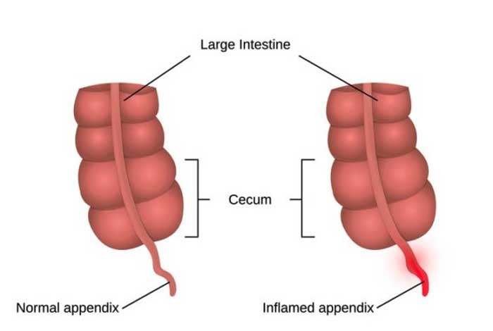 causes of appendicitis
