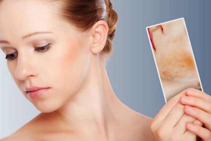 diagnosis and tests of acne