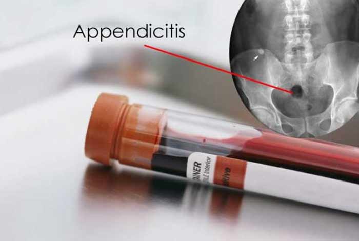 diagnosis and tests of appendicitis