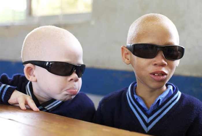 prevention for albinism