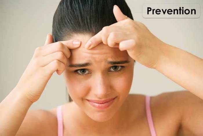 prevention of acne