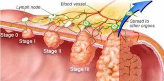 research suggests colon cancer screening should be in early 40s and not at