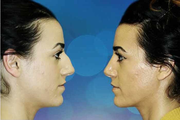 rhinoplasty might make you more attractive healthier and successful