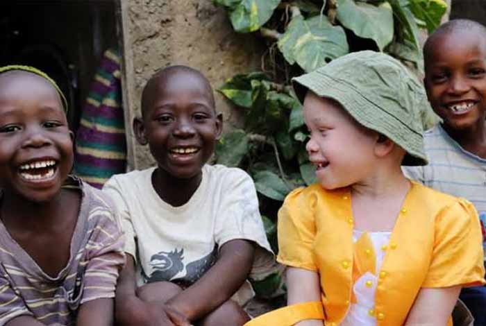 risk factors of albinism