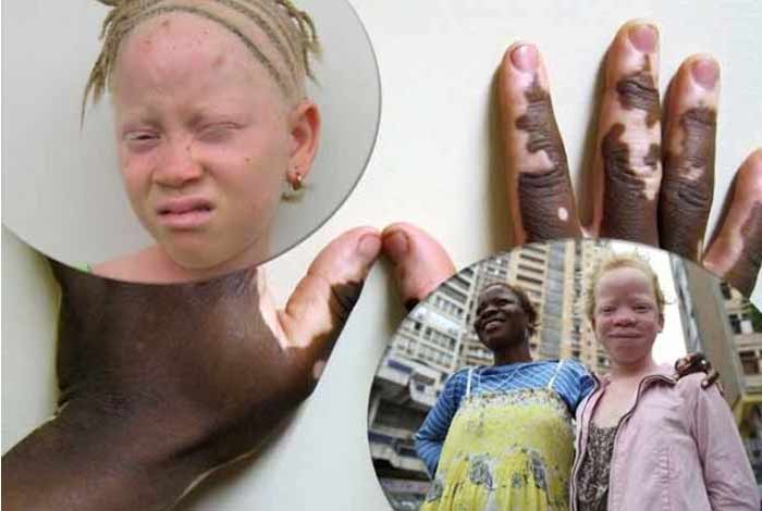 symptoms of albinism