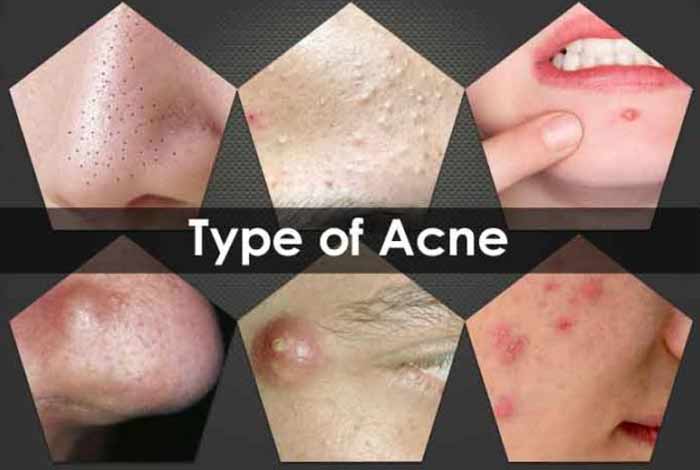 types and symptoms of acne