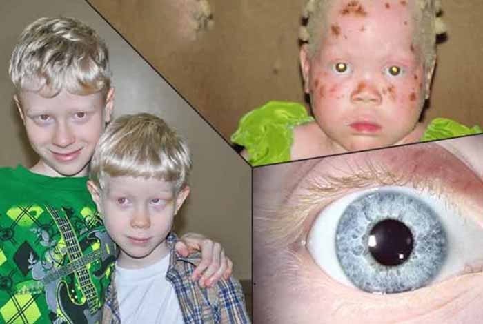 types and symptoms of albinism