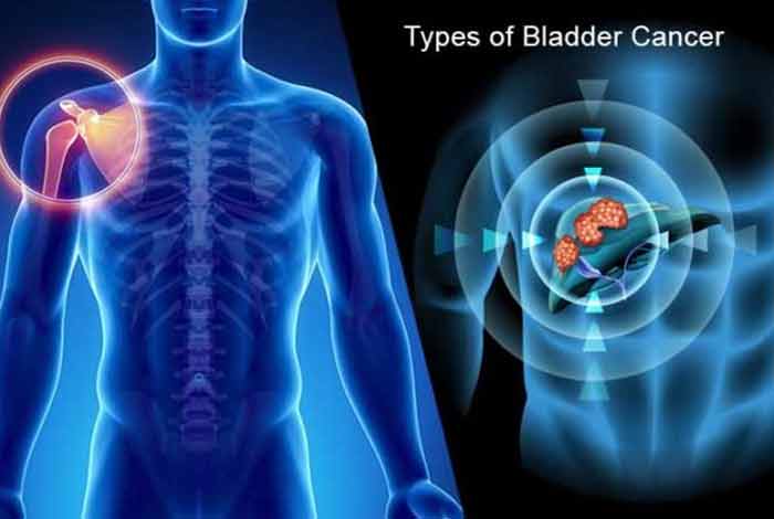types and symptoms of bladder cancer