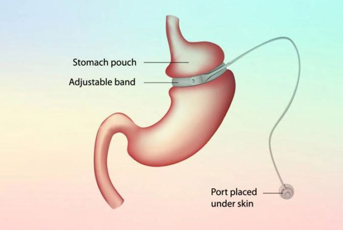 adjustable gastric banding 