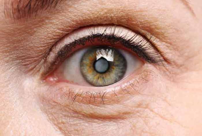 cataracts types symptoms causes prevention and treatment
