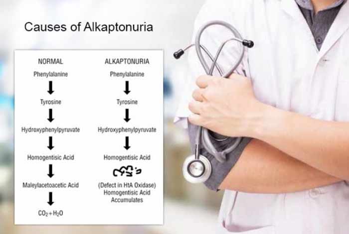 causes of alkaptonuria