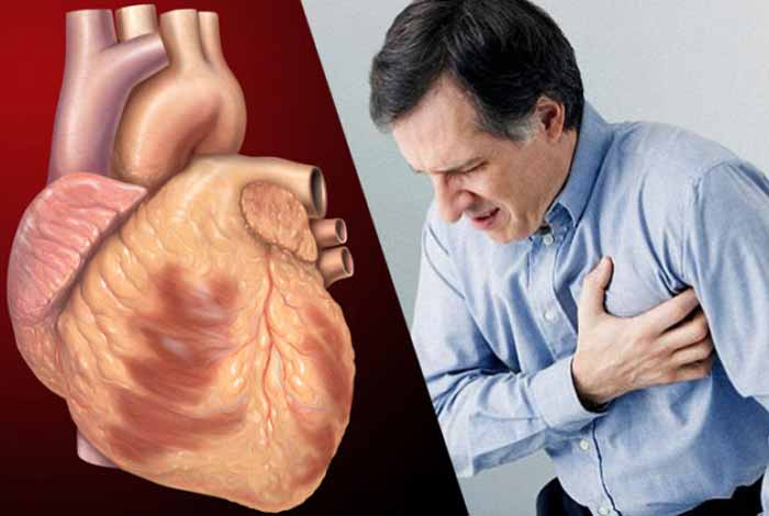 coronary artery disease types symptoms causes risk factors and treatment