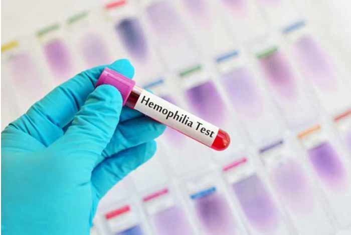 diagnosis and tests for hemophilia