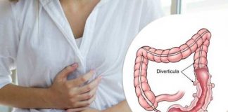 diverticulitis causes symptoms diagnosis prevention and treatment