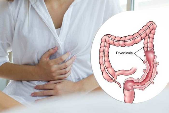 diverticulitis causes symptoms diagnosis prevention and treatment