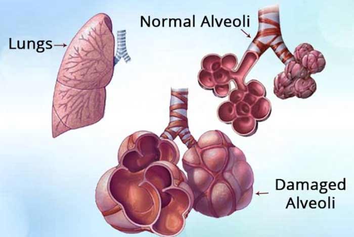 Emphysema - Types, Symptoms, Causes, Prevention and Treatment
