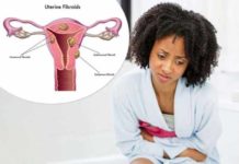 hair loss fibroids and ethnicity is there any association