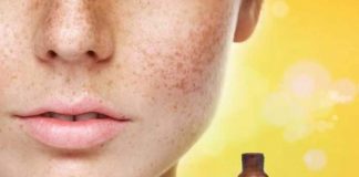 homeopathic all natural ways to cure face pigmentation