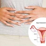 ovarian cancer types symptoms causes diagnosis and treatment