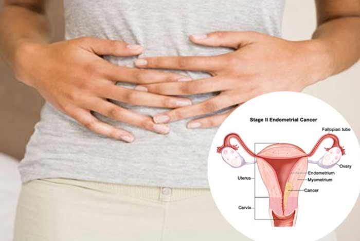 ovarian cancer types symptoms causes diagnosis and treatment