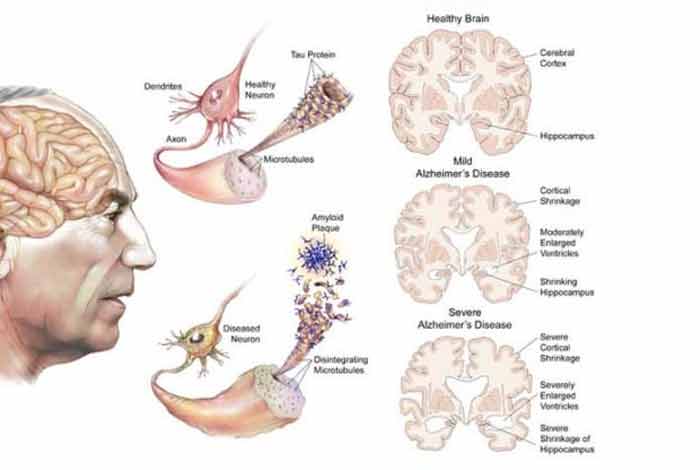 types and symptoms of alzheimer’s disease