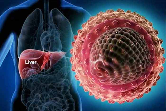 Image result for Viral hepatitis