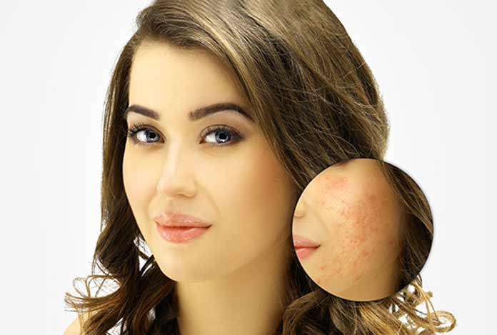 Easy Acne Scars Treatment with Dr. Harold Lancer