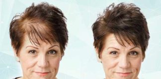 7 Most Effective Home Remedies for Hair Thinning