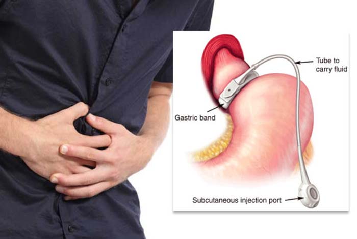 adjustable gastric banding