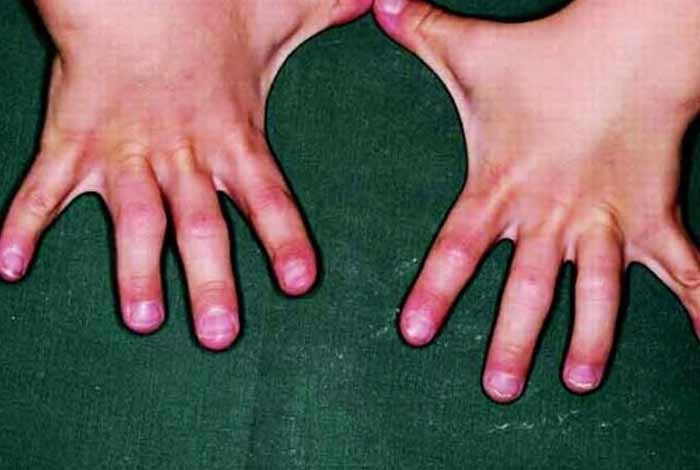 causes and prevention of aarskog syndrome