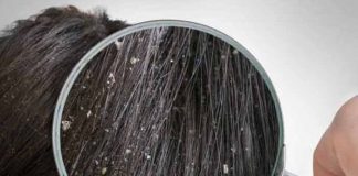 dandruff definition types causes prevention and treatment at home
