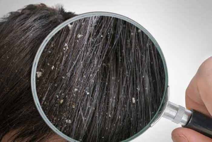 dandruff definition types causes prevention and treatment at home