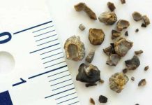 kidney stone symptoms causes prevention and treatment