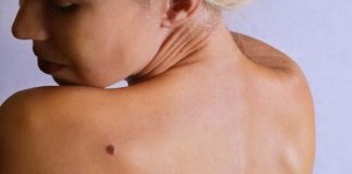 proven home remedies to remove skin tags naturally