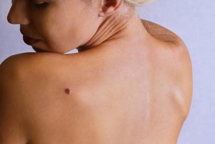 proven home remedies to remove skin tags naturally