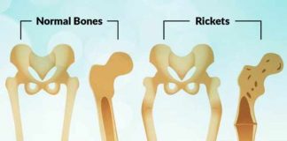 rickets types symptoms causes prevention and treatment