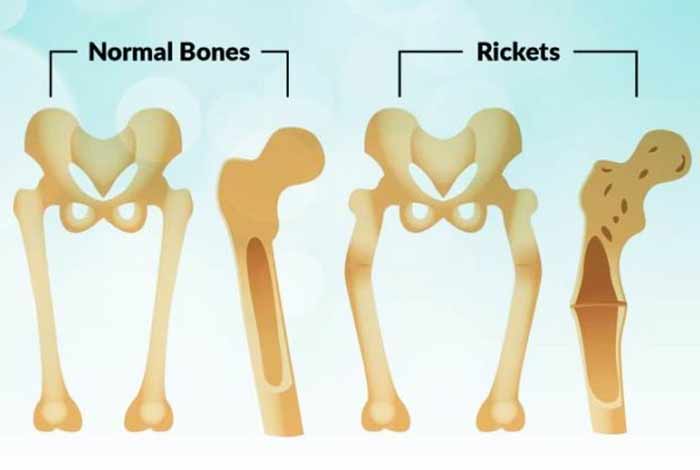 rickets types symptoms causes prevention and treatment