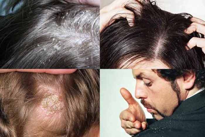 types and symptoms of dandruff